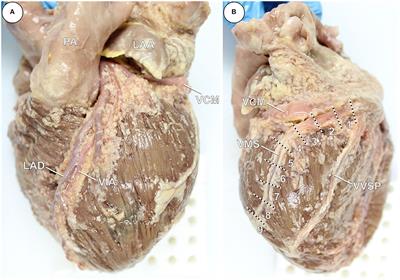 Morphometric Characterization of Human Coronary Veins and Subvenous Epicardial Adipose Tissue—Implications for Cardiac Resynchronization Therapy Leads